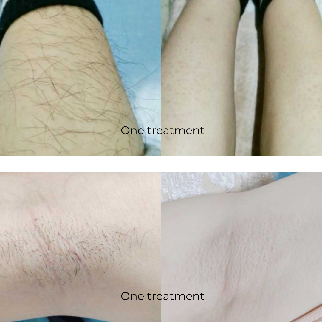 Torno Elite Diode Laser Hair Removal Machine (4 Wavelengths)