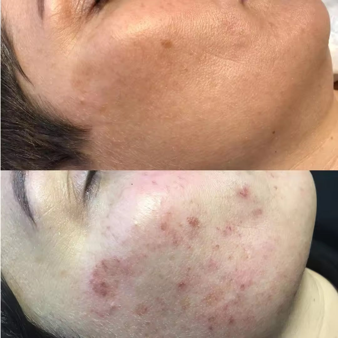 Youth Pro IPL Skin Rejuvenation Machine 3 in 1